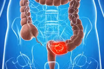 Sụt cân bất thường, đi khám phát hiện... ung thư đại tràng giai đoạn cuối