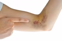 Dấu hiệu cơ thể thiếu hụt vitamin K, cần bổ sung ngay