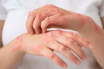 3 triệu chứng của vảy nến mà người bệnh nào cũng gặp phải