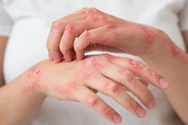 3 triệu chứng của vảy nến mà người bệnh nào cũng gặp phải