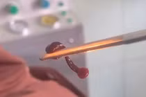 Gắp con vắt dài 3 cm sống trong mũi người đàn ông ở Quảng Bình