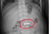 Cháu bé ở Quảng Trị nuốt phải cây đinh vít xoắn nhọn