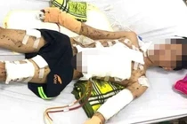 Nam sinh bị giập nát hai bàn tay do tự chế pháo ở nhà