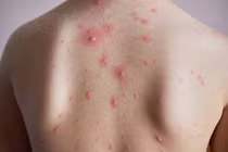 Bến Tre: Phát hiện hơn 80 ca mắc thủy đậu tại một công ty