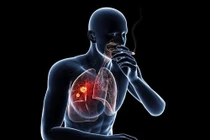 Nhiều bệnh về ung thư có nguyên nhân từ hút thuốc lá