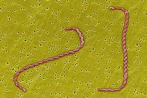 Sốt, đau đầu tưởng “ốm xoàng”, đi khám phát hiện vi khuẩn gây viêm màng não 