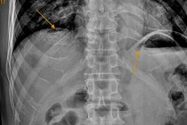 Thường xuyên uống rượu, người đàn ông bị thủng tạng rỗng