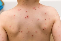 Số ca mắc sởi năm 2024 tăng 130 lần