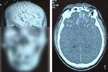 Người đàn ông 45 tuổi bị thương tích nặng vùng đầu, mặt do pháo nổ