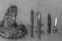 Thủng ruột vì hội chứng thích ăn đồ vật