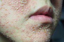 Mặt sưng phù, bỏng rộp... vì sử dụng "thần dược" trắng da