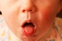 Biến chứng nguy hiểm của bệnh ho gà cần cảnh giác