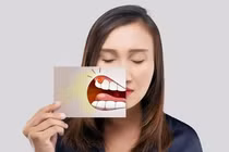 5 dấu hiệu ở miệng có thể "cảnh báo" gan đang gặp vấn đề