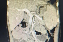 Phẫu thuật cứu trẻ thoát vị hoành thận lạc chỗ trên lồng ngực, phổi biệt lập