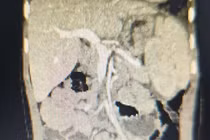 Phẫu thuật cứu trẻ thoát vị hoành thận lạc chỗ trên lồng ngực, phổi biệt lập