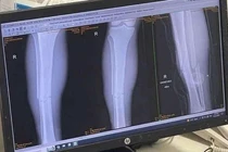 Chuyên gia lên tiếng về tình trạng chấn thương của cầu thủ Xuân Son