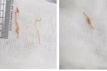 Trẻ bị sặc thức ăn - phụ huynh không nên chủ quan