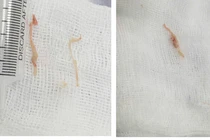 Trẻ bị sặc thức ăn - phụ huynh không nên chủ quan