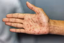 Những bệnh lây truyền qua đường tình dục phổ biến nhất