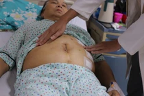 Đặt lưới nhân tạo cho bà cụ 79 tuổi