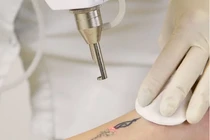 Xóa xăm có để lại sẹo không?