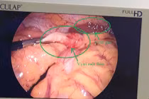 Nội soi cắt viêm ruột thừa ở vị trí hiếm gặp