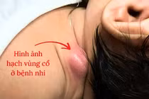 Hạch vùng đầu mặt cổ ở trẻ em có nguy hiểm?