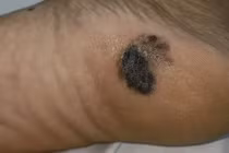 Phát hiện mắc ung thư từ nốt đen lạ ở gót chân