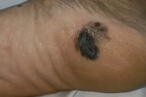 Phát hiện mắc ung thư từ nốt đen lạ ở gót chân