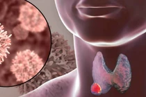 Mất ngủ coi chừng bệnh lý tuyến giáp