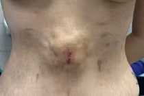 Chi 110 triệu đồng để hút mỡ, tạo hình, người phụ nữ nhận "cái kết đắng"