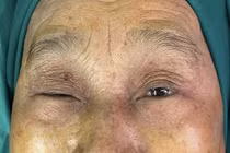 Treo mi bằng vạt cơ trán tránh sụp mi mắt tái phát