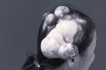 Bệnh ung thư khiến người phụ nữ "mọc sừng" kỳ lạ trên đầu