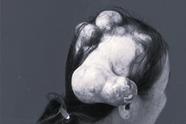 Bệnh ung thư khiến người phụ nữ "mọc sừng" kỳ lạ trên đầu