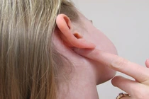 3 giờ phẫu thuật bóc khối u tuyến mang tai cho người phụ nữ 36 tuổi