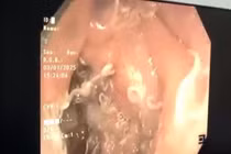 Giật mình hàng trăm con giun "trú ngụ" trong đường tiêu hóa người phụ nữ