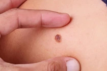 Ung thư da từ 1 nốt chấm nhỏ sẫm màu, bác sĩ cảnh báo