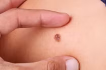 Ung thư da từ 1 nốt chấm nhỏ sẫm màu, bác sĩ cảnh báo