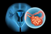 Buồng trứng đa nang làm tăng nguy cơ cao huyết áp ở tuổi vị thành niên