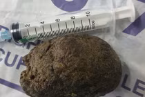 Nhập viện cấp cứu sau khi ăn 3 quả hồng ngâm