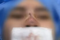 Cô gái trẻ bị thủng mũi sau 3 tháng căng chỉ nâng mũi