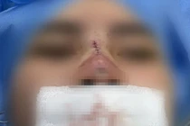 Cô gái trẻ bị thủng mũi sau 3 tháng căng chỉ nâng mũi