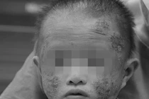 Bé trai 1 tuổi phồng rộp mặt, bác sĩ chỉ rõ nguyên nhân