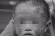 Bé trai 1 tuổi phồng rộp mặt, bác sĩ chỉ rõ nguyên nhân
