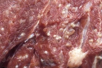 Ho nhiều, chảy nước mũi... bệnh nhân được chẩn đoán nhiễm sán dây lợn