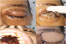 Vì sao bệnh nấm đen hiếm gặp nhưng nguy hiểm?