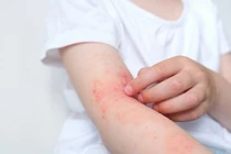 Trẻ bị lở loét toàn thân do dị ứng chậm