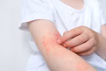 Trẻ bị lở loét toàn thân do dị ứng chậm