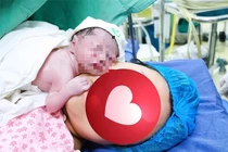 Cứu thai nhi thiểu ối, chậm tăng trưởng 26 tuần tuổi bằng truyền ối