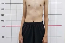 Nam sinh 14 tuổi đã cao gần 2m, bác sĩ chỉ rõ lý do